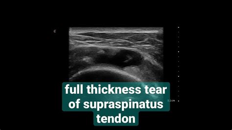 supraspinatus tear testing|full thickness tear supraspinatus.